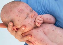 موثرترین راه پیشگیری از بیماری سرخک و سرخجه واکسیناسیون است