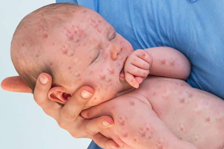 موثرترین راه پیشگیری از بیماری سرخک و سرخجه واکسیناسیون است